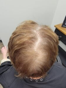 top of head with thinning hair